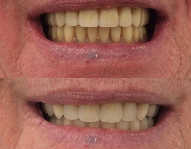 False Teeth Brisbane