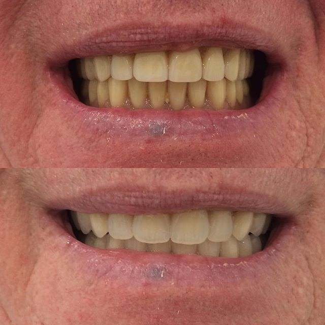 False Teeth Brisbane