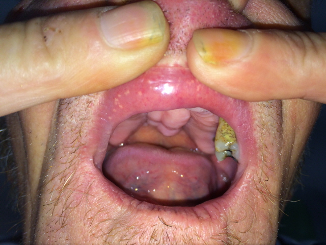 Denture Treatment