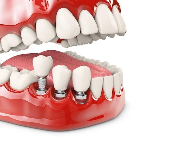 What exactly are permanent dentures?